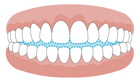 開咬（オープンバイト）の歯並びイラスト