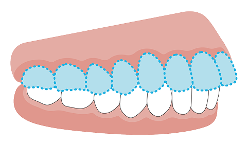 過蓋咬合（ディープバイト）の歯並びイラスト