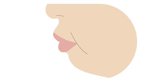 口ゴボ（上下顎前突）の歯並びイラスト