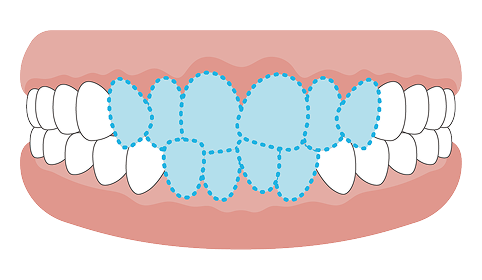 がたがた（叢生）の歯並びイラスト