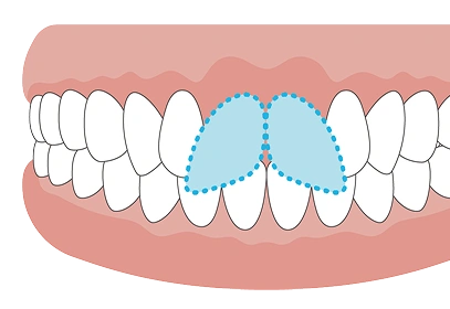 出っ歯（上顎前突）の歯並びイラスト