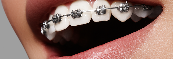 成人矯正のイメージ