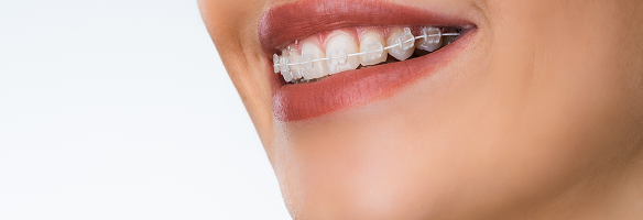 表側矯正のイメージ