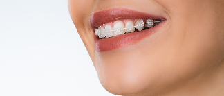 表側矯正のイメージ