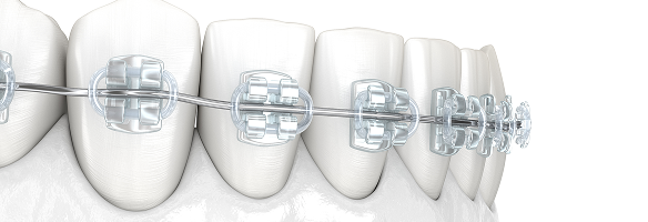 部分矯正のイメージ