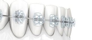 部分矯正のイメージ