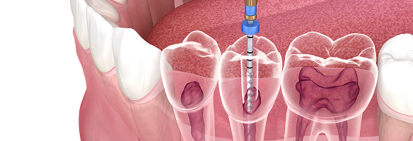 歯内療法のイメージ