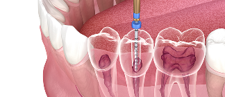 歯内療法のイメージ