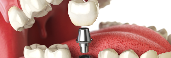 インプラント治療のイメージ