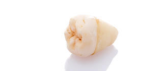 抜歯のイメージ