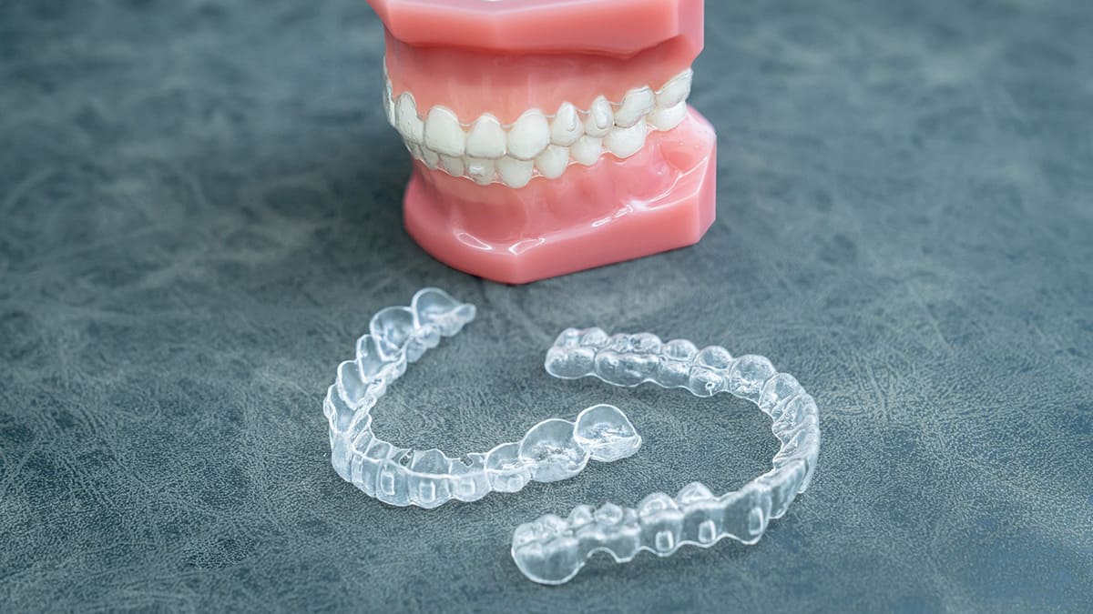 マウスピース型矯正装置（インビザライン）の外観