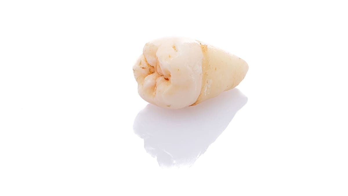 矯正治療に伴う抜歯の説明