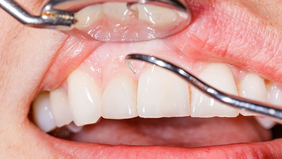 矯正中の歯周病治療とメンテナンス