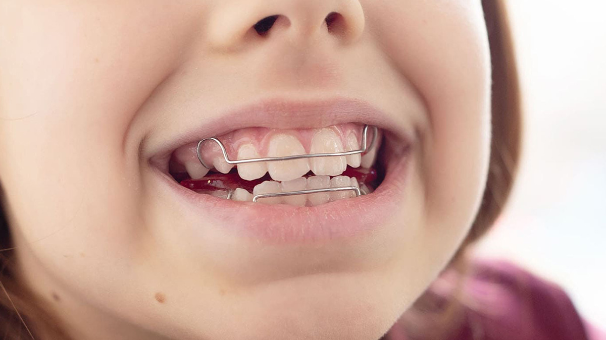 小児矯正の治療方針をご家族に説明するカウンセリング