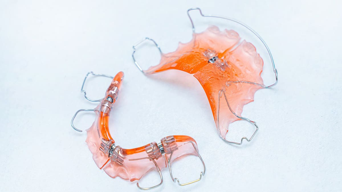 拡大床を使用した小児の床矯正