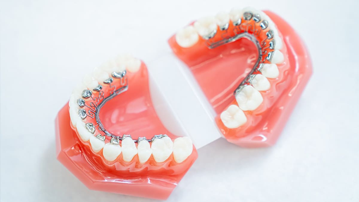 リンガルアーチ（舌側弧線装置）の固定式矯正装置