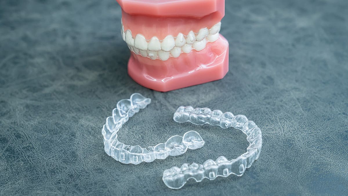 小児向けのマウスピース型矯正装置