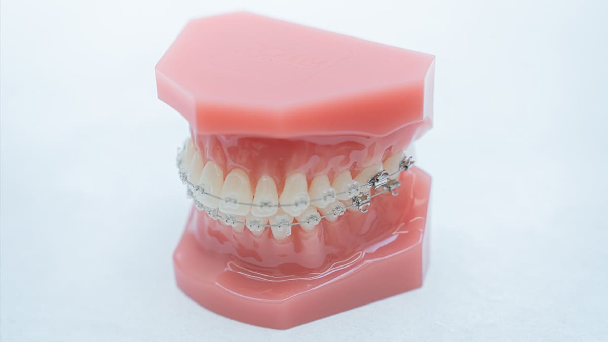 小児の表側矯正（ブラケットとワイヤー）