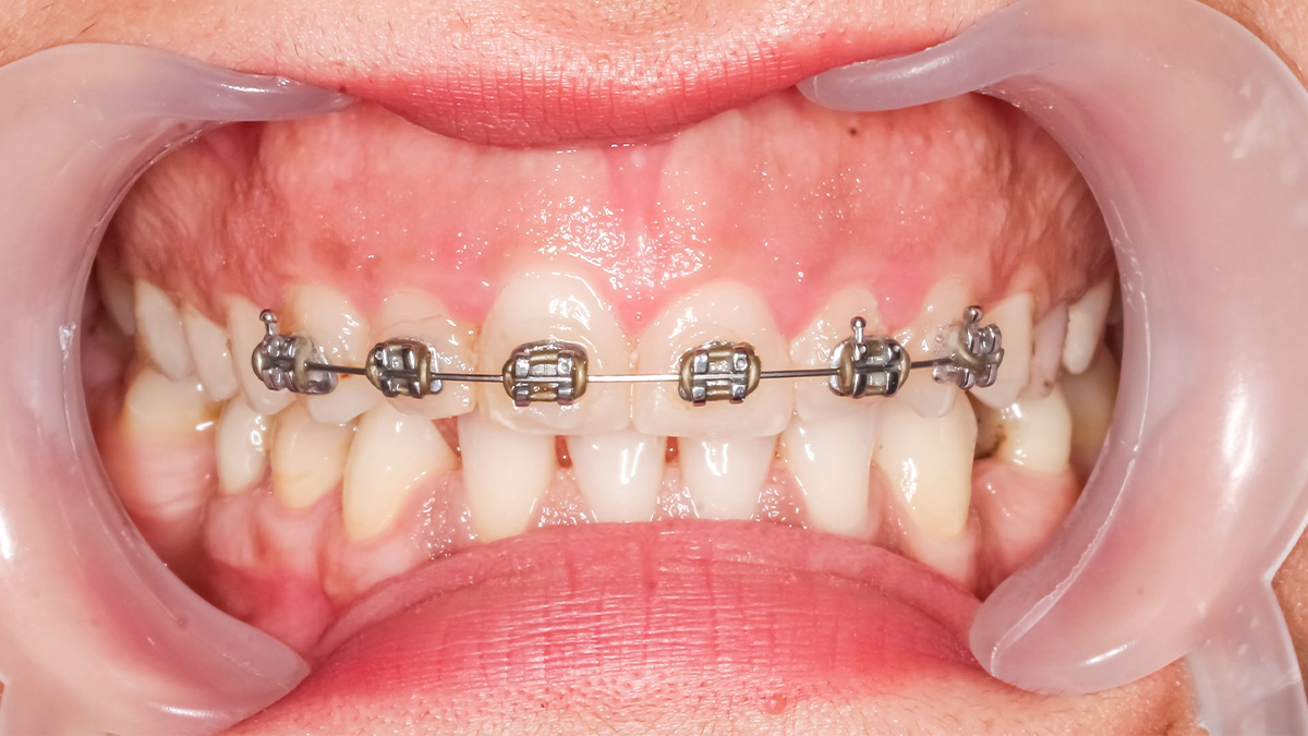 部分矯正で使用するブラケットとワイヤーの装置