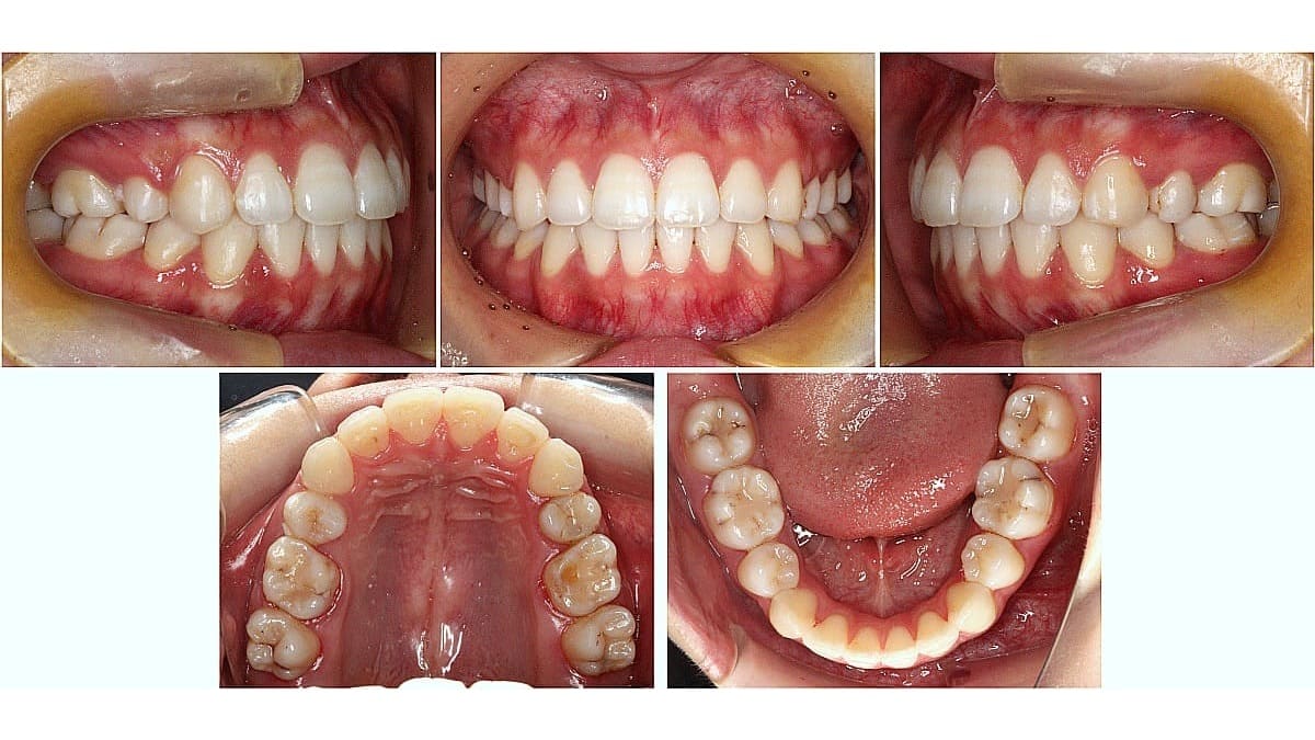 矯正症例の症例 治療後