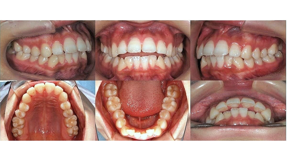 矯正症例の症例 治療前