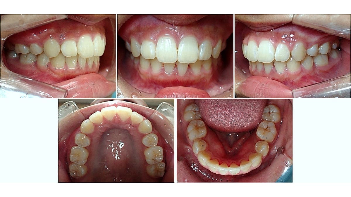 矯正症例の症例 治療後