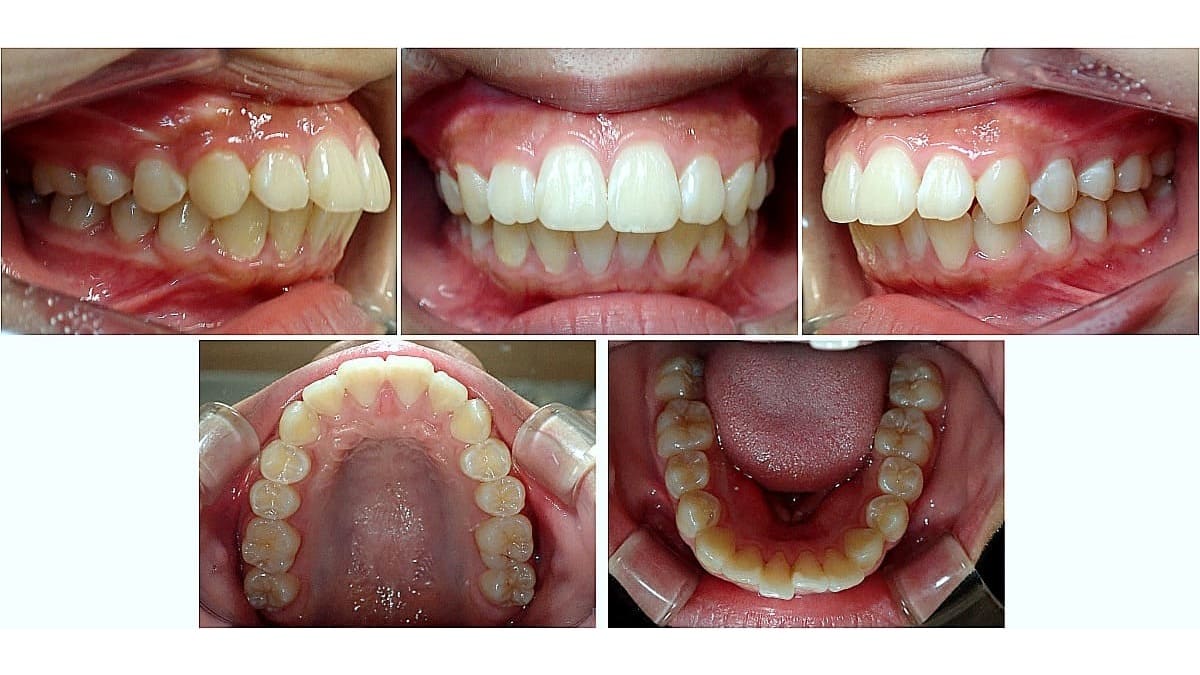 矯正症例の症例 治療前