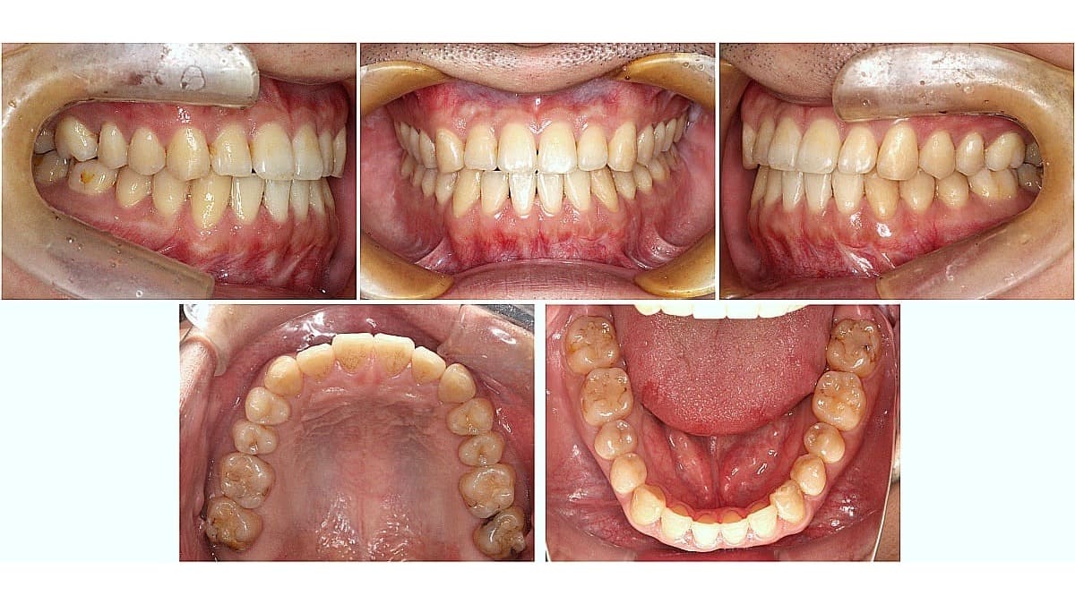矯正症例の症例 治療後