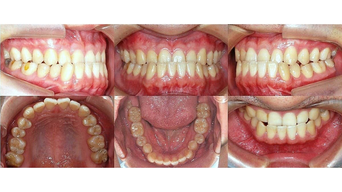 矯正症例の症例 治療前