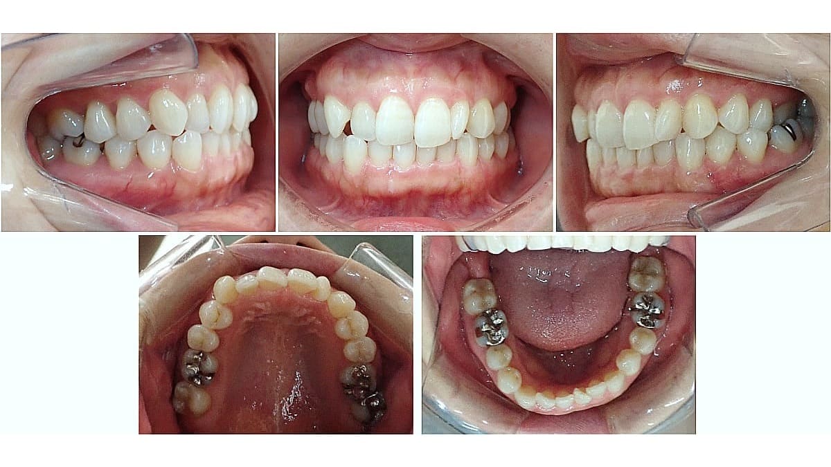 矯正症例の症例 治療前