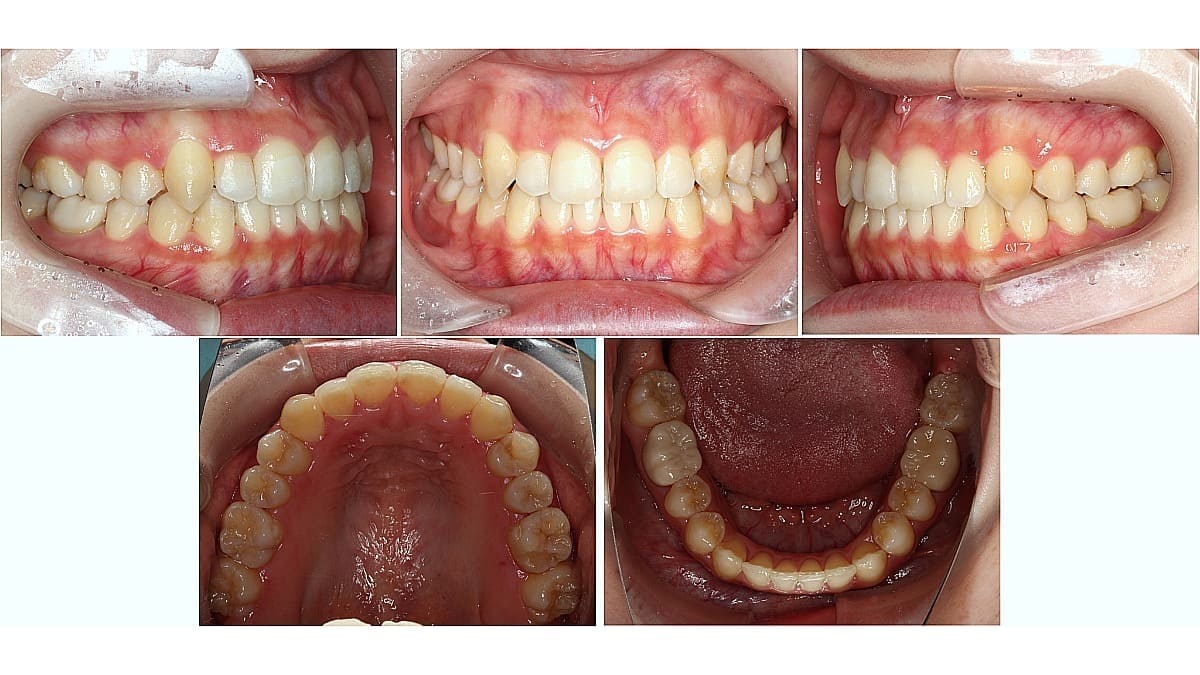 矯正症例の症例 治療後