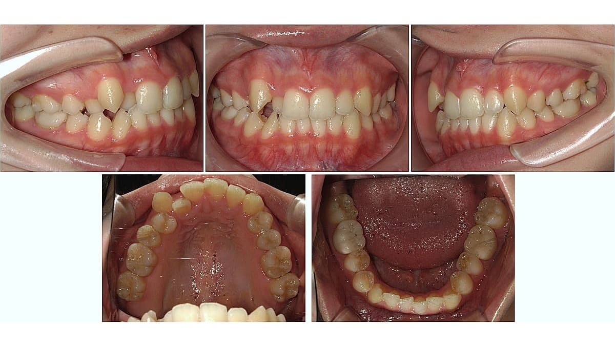 矯正症例の症例 治療前