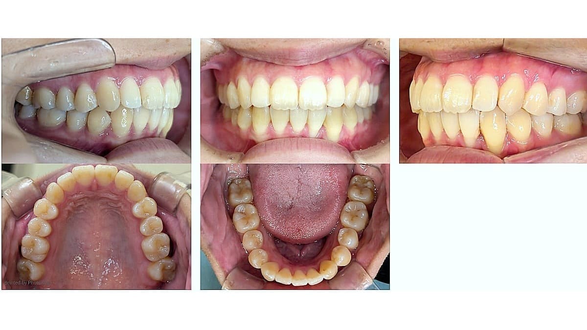 矯正症例の症例 治療後